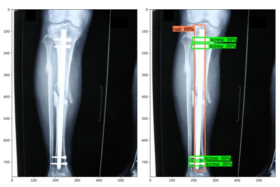 Two X-ray images, one with an implant identified using machine learning.