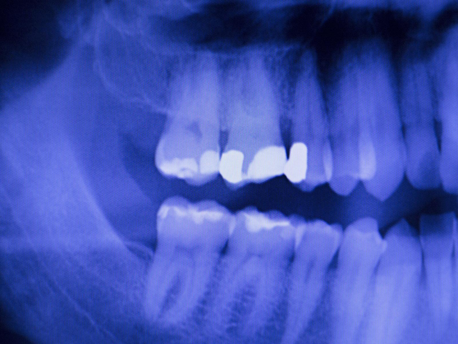 Scientists Show How One Cause of Weak Enamel Unfolds on the Molecular