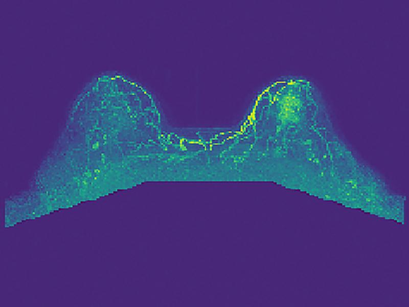 Deep Learning Targets Breast Cancer Detection