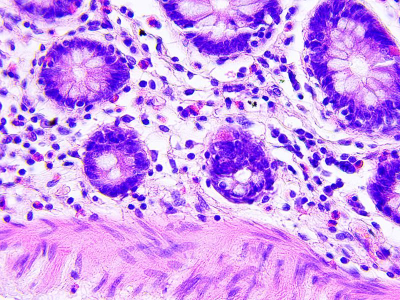 Colon cancer cells