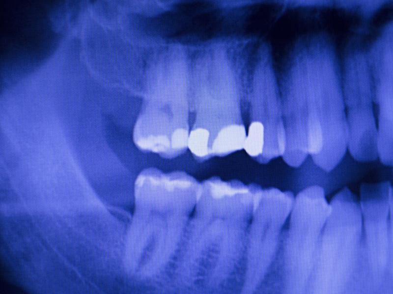 Tooth enamel X-ray
